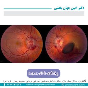 پرفشاری داخل جمجمه