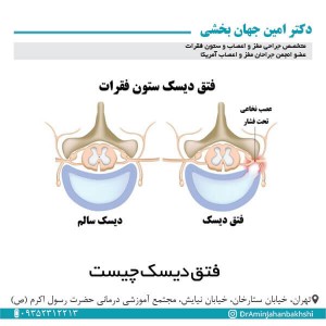 فتق دیسک چیست