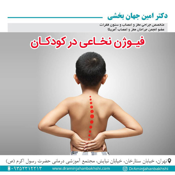 فیوژن نخاعی در کودکان