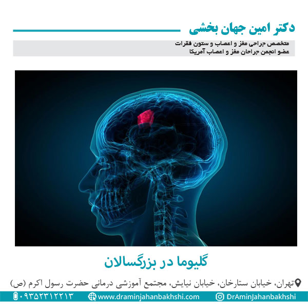 گلیوما در بزرگسالان