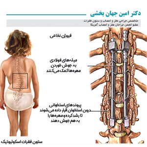 فیوژن نخاعی در کودکان