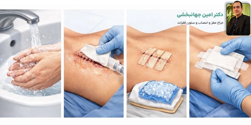 نحوه تعویض پانسمان مراقبت از زخم و بخیه بعد از دیسککتومی