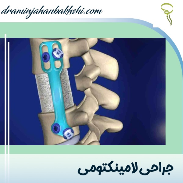 لامینکتومی