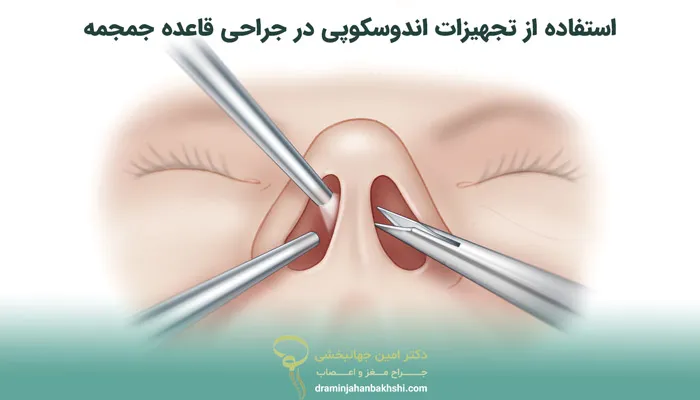 جراحی آندوسکوپی قاعده جمجمه