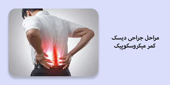 جراحی میکروسکوپیک دیسک کمر برای دیسکهای متعدد چگونه است؟