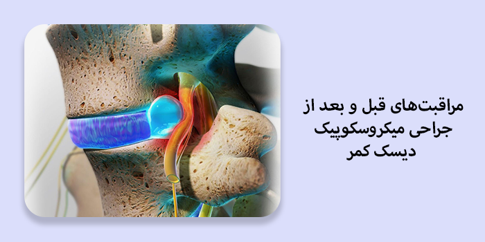 مراقبتهای قبل از جراحی میکروسکوپیک دیسک کمر