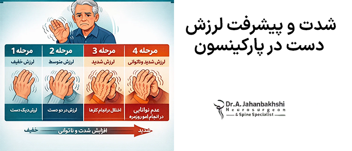 شدت و پیشرفت لرزش دست در پارکینسون