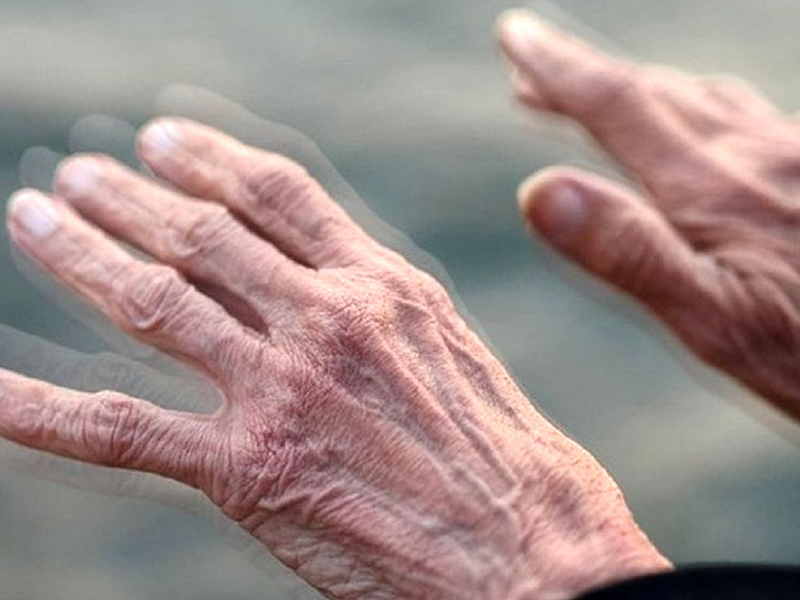 لرزش دست پارکینسونی